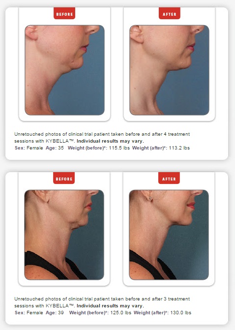 Ready to let your double chin go? Call board-certified Greenwood, SC plastic surgeon Dr. Ted Vaughn at 864-223-0505 to learn how we can help