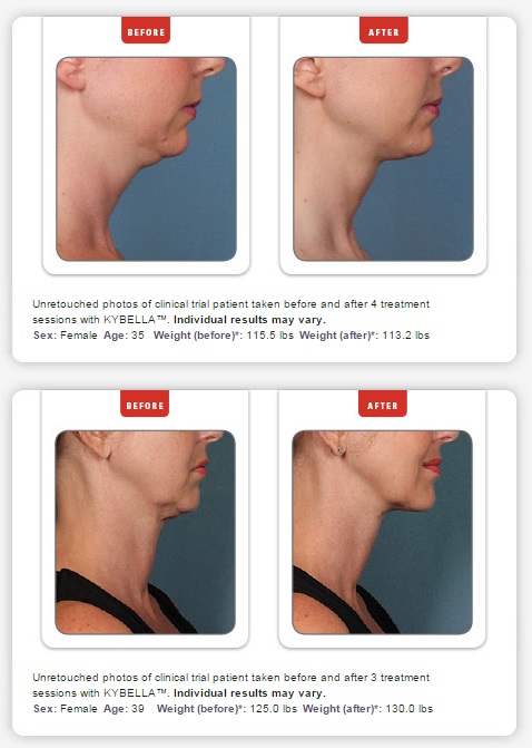 Kybella before and after