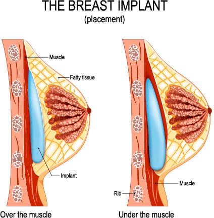 Breast implant placement locations