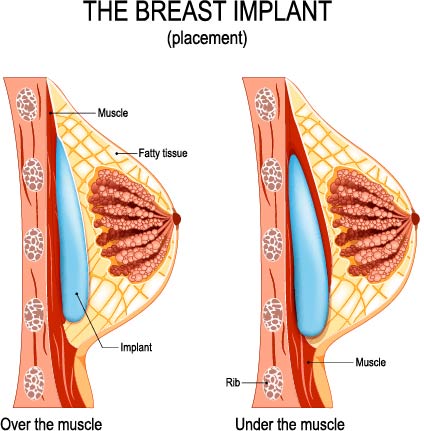 Breast Augmentation Surgery