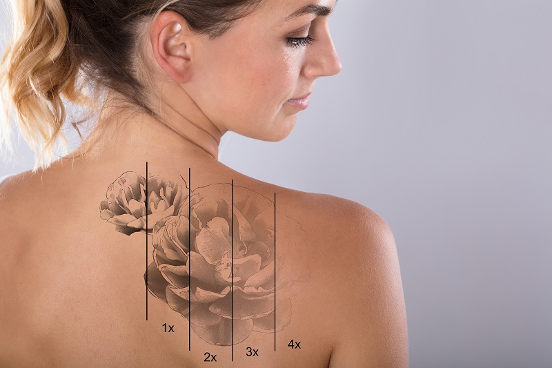 Laser tattoo removal Lane Cove Sydney #1 cheap special save