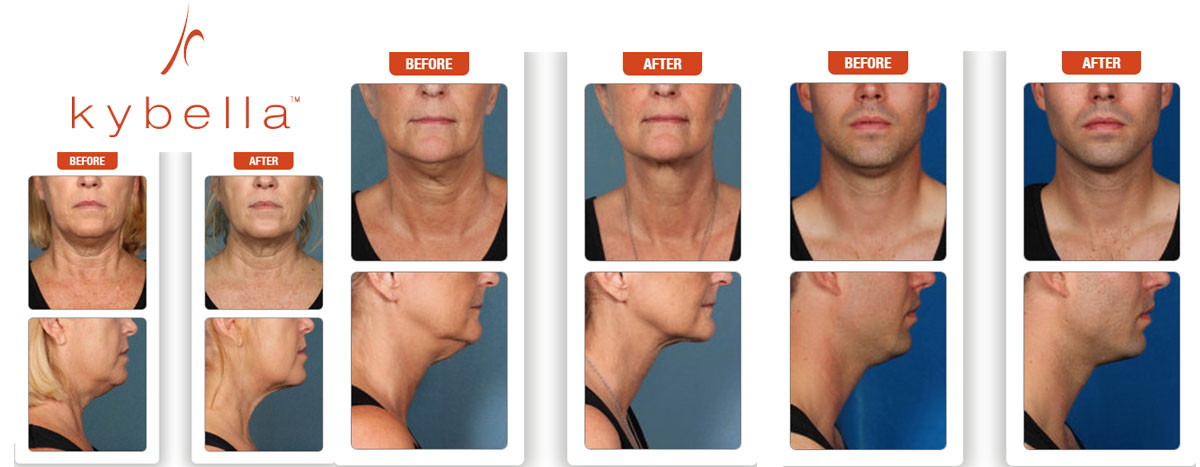 Kybella before and after photos